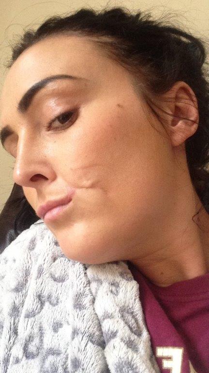 Kate Nield face bitten off