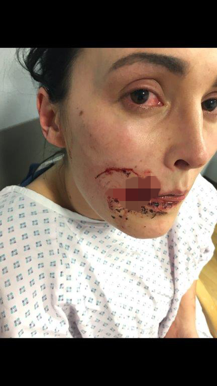 Kate Nield face bitten off