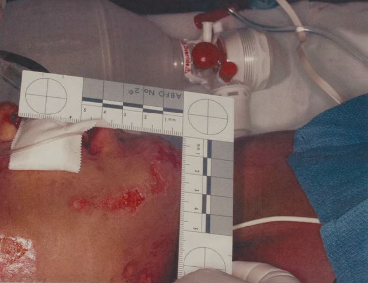  The little boy was left with severe burns to his neck area