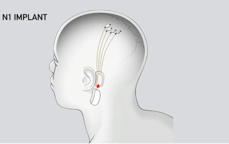The chip would allow people to interact with computers using their brains