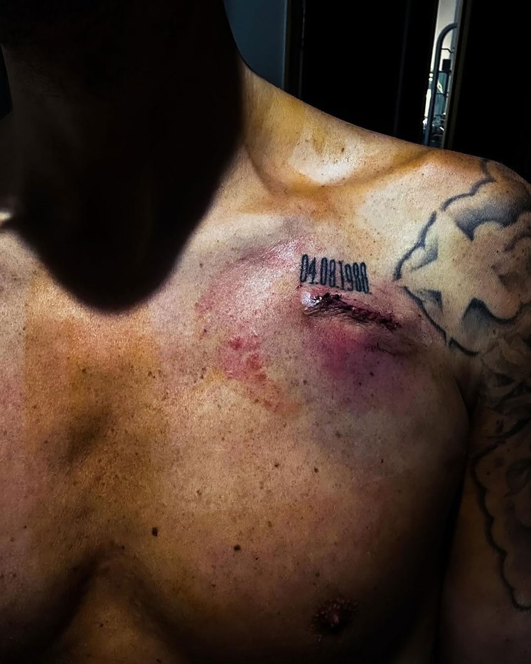 Close-up of a man's chest showing a pacemaker incision.
