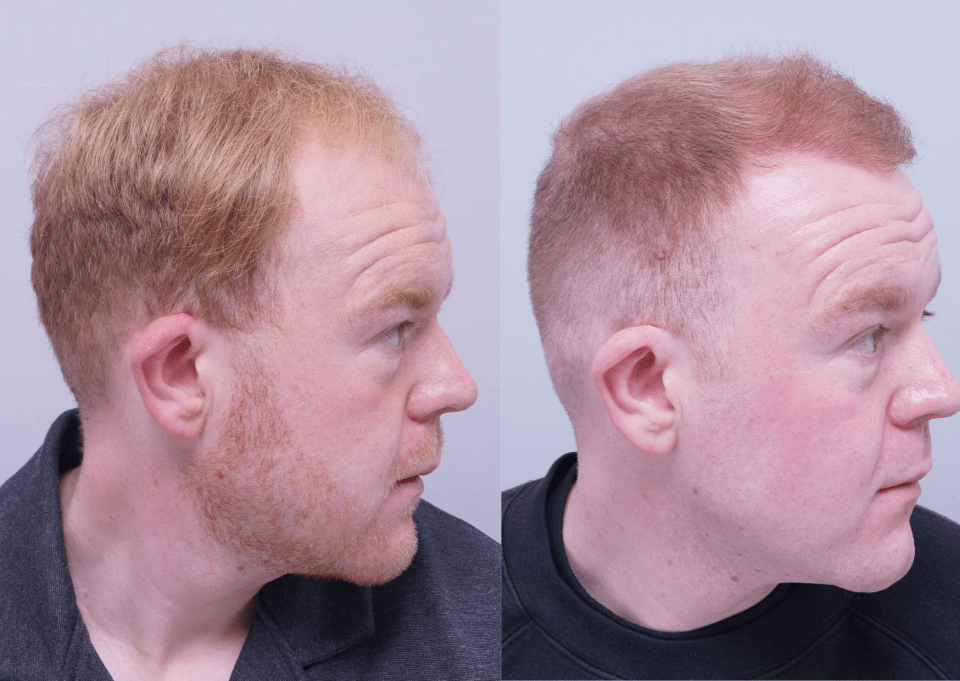Before and after photos of a man's hair transplant.