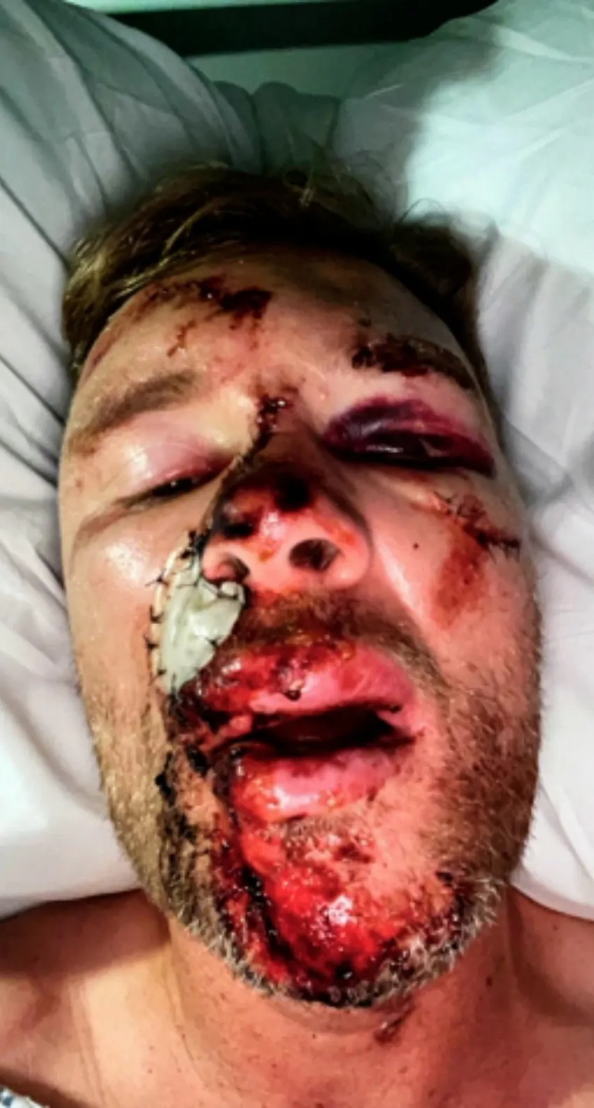 Freddie was left with life-changing injuries following the crash