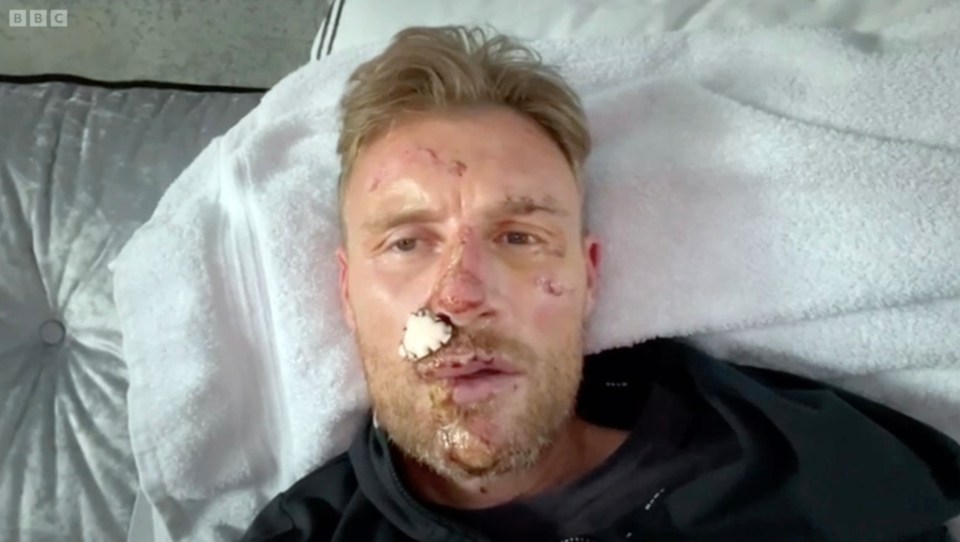 Freddie Flintoff with facial injuries after a Top Gear crash.