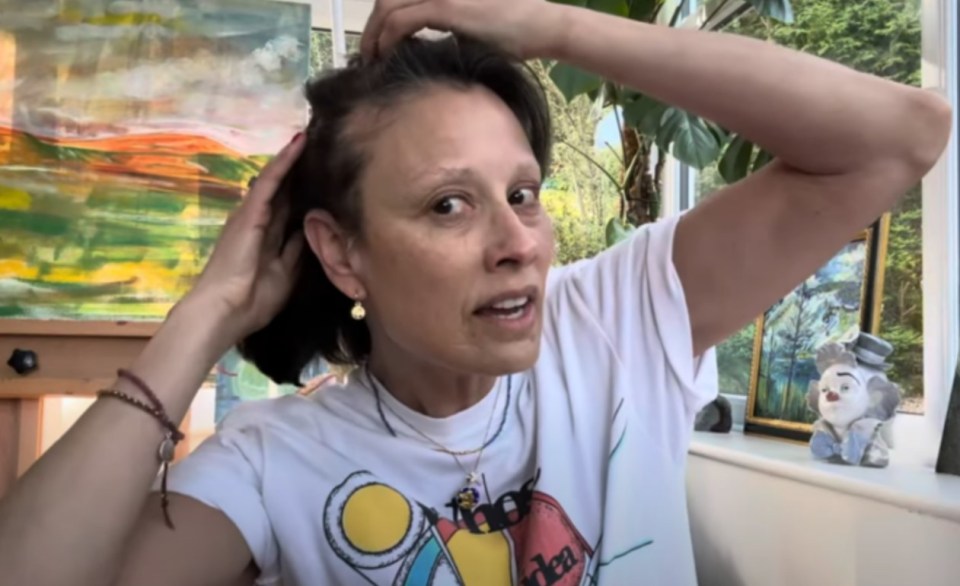 Woman showing hair loss.