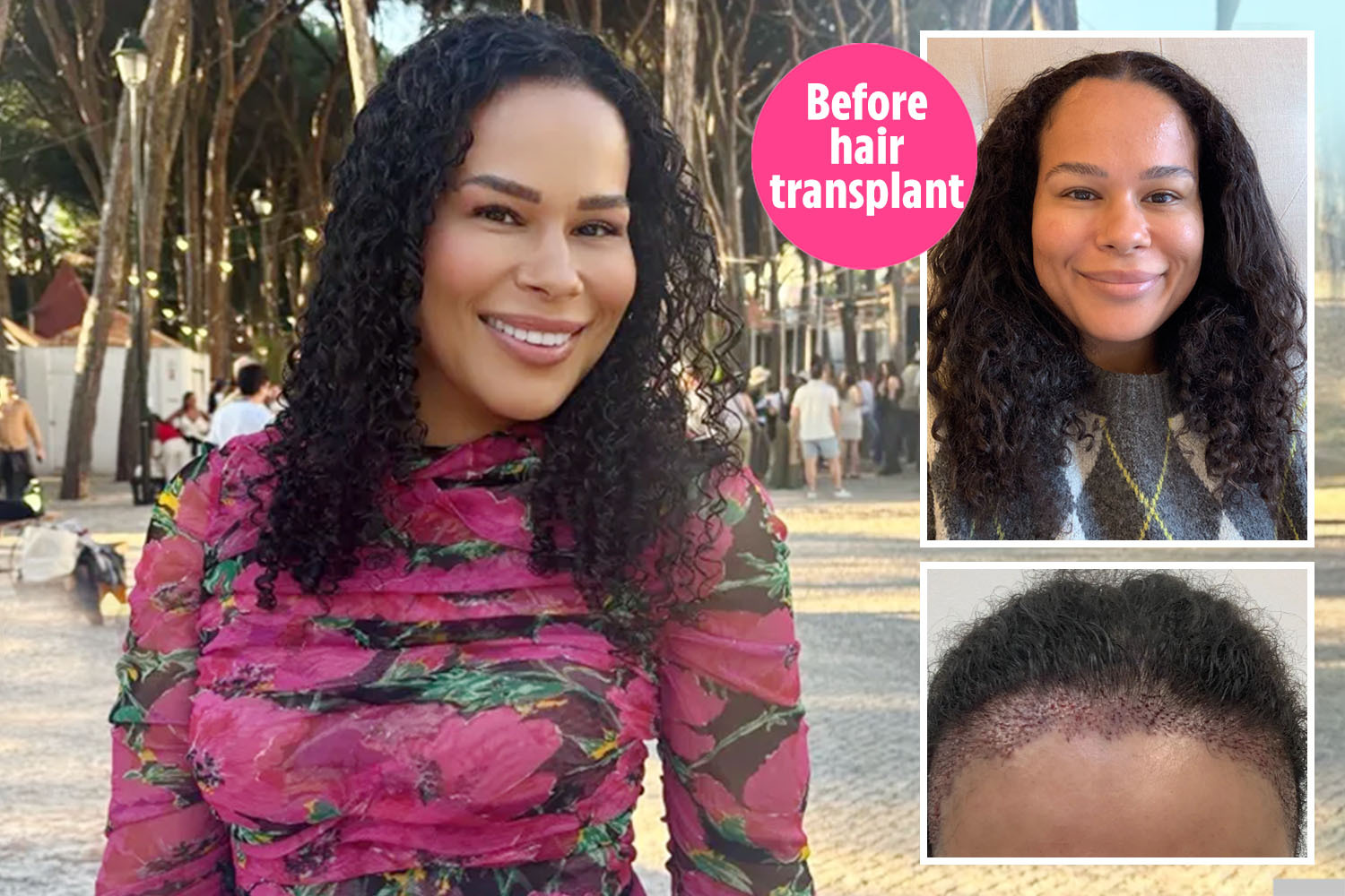 Before and after photos of a woman's hair transplant.