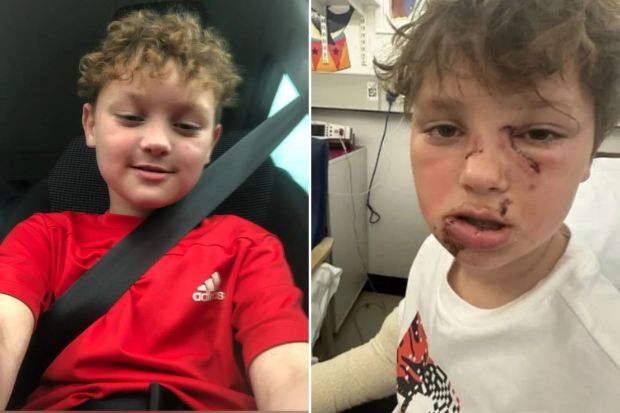 An image collage containing 2 images, Image 1 shows Weston Kiesler, an eight-year-old boy, in a red shirt, Image 2 shows Eight-year-old boy with facial injuries after a dog attack